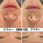美肌プラン：お悩み別(フォトor脱毛＋肌別パック)のフェイシャルエステで全顔、首までハリツヤUP(120分)