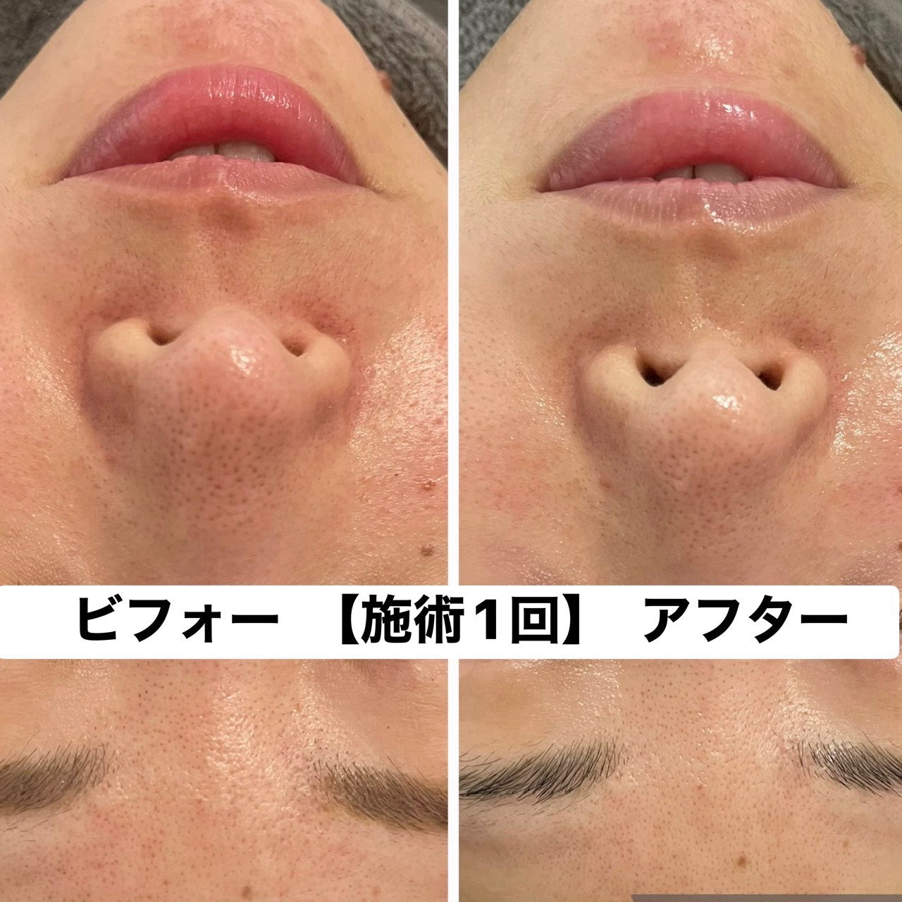 美肌プラン：お悩み別(フォトor脱毛＋肌別パック)のフェイシャルエステで全顔、首までハリツヤUP(120分)